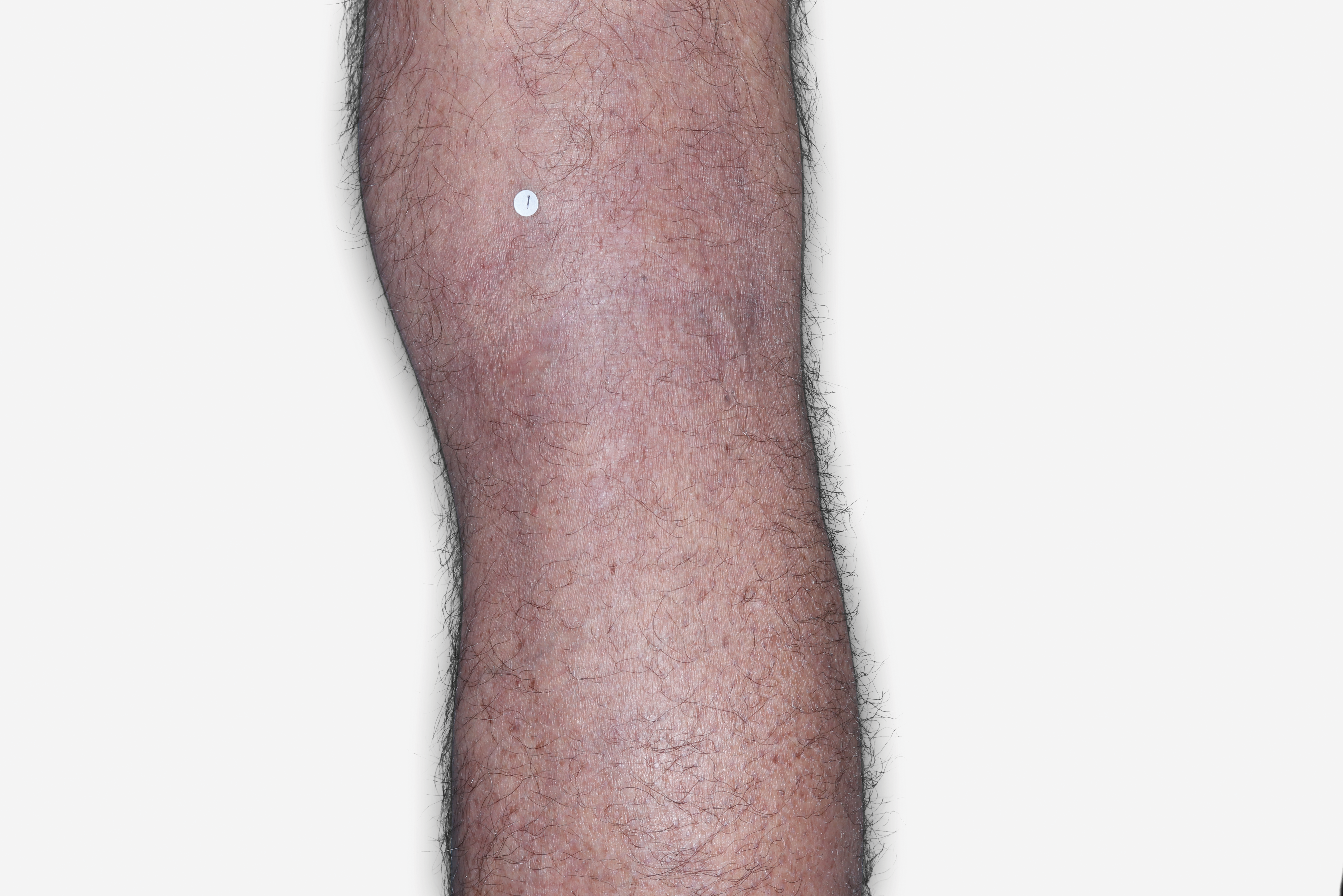 After Treatment - A patient with clear skin, back of knee shown.