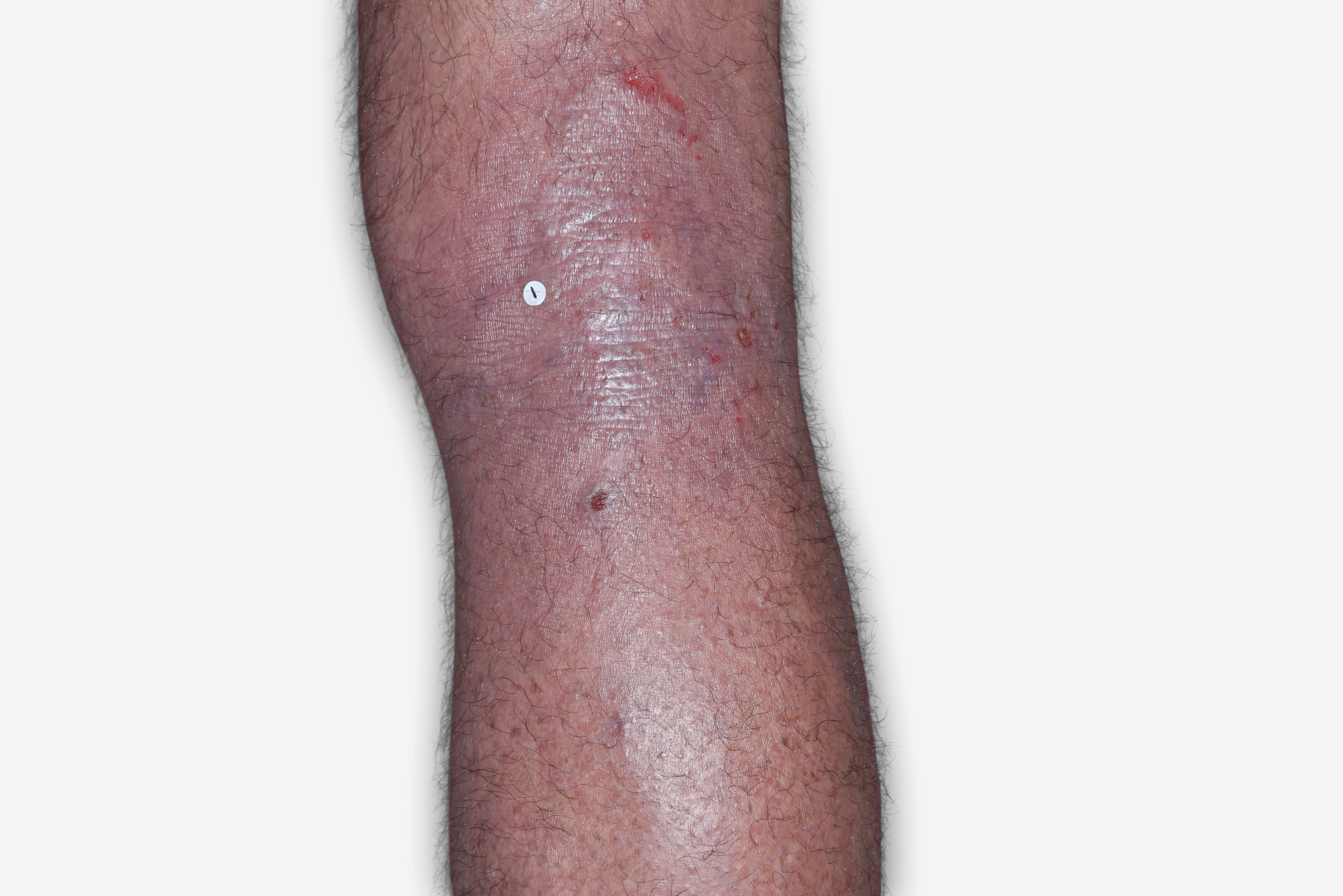 A patient image of the back of the knee