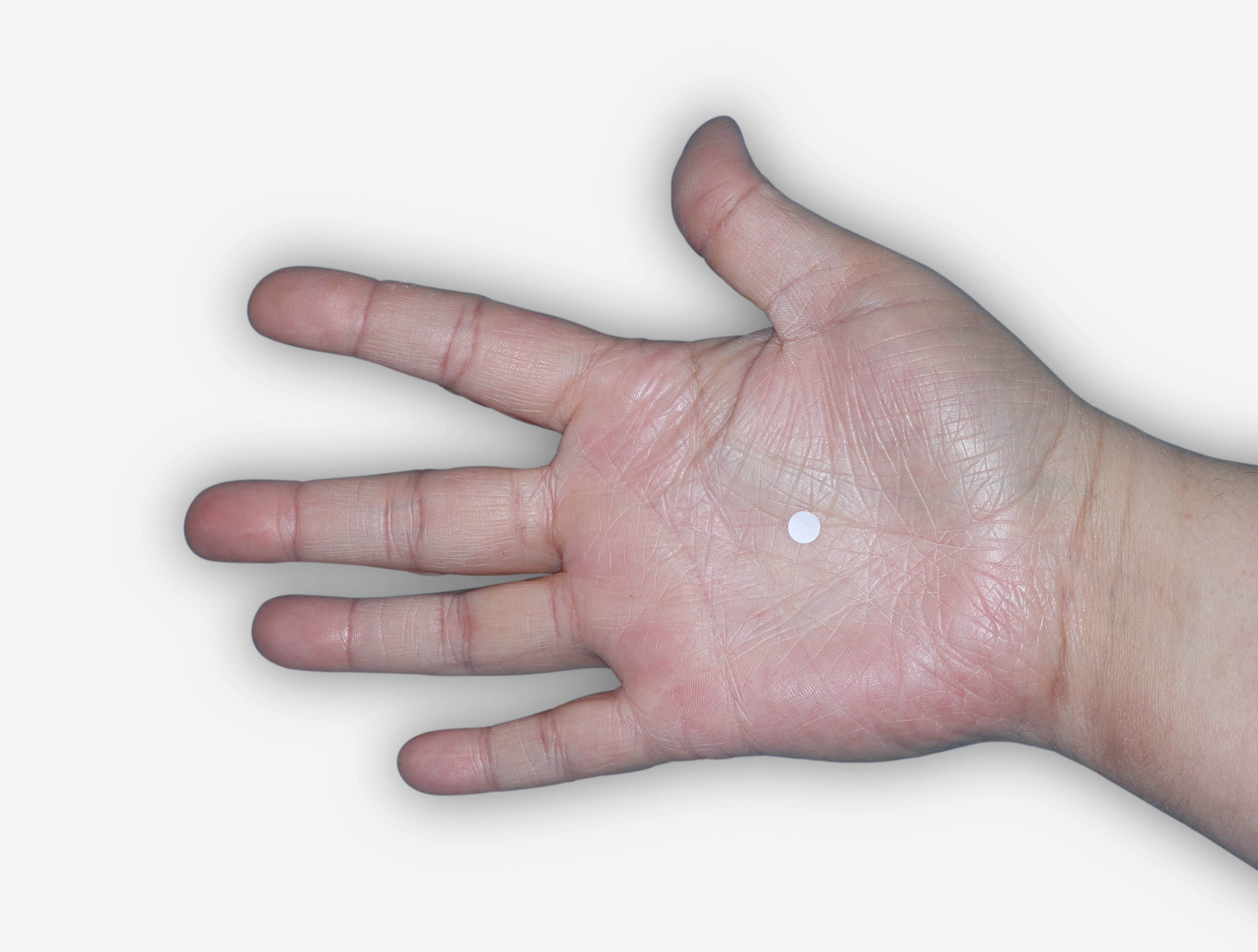 After Treatment - A patient with almost clear skin, palm shown.