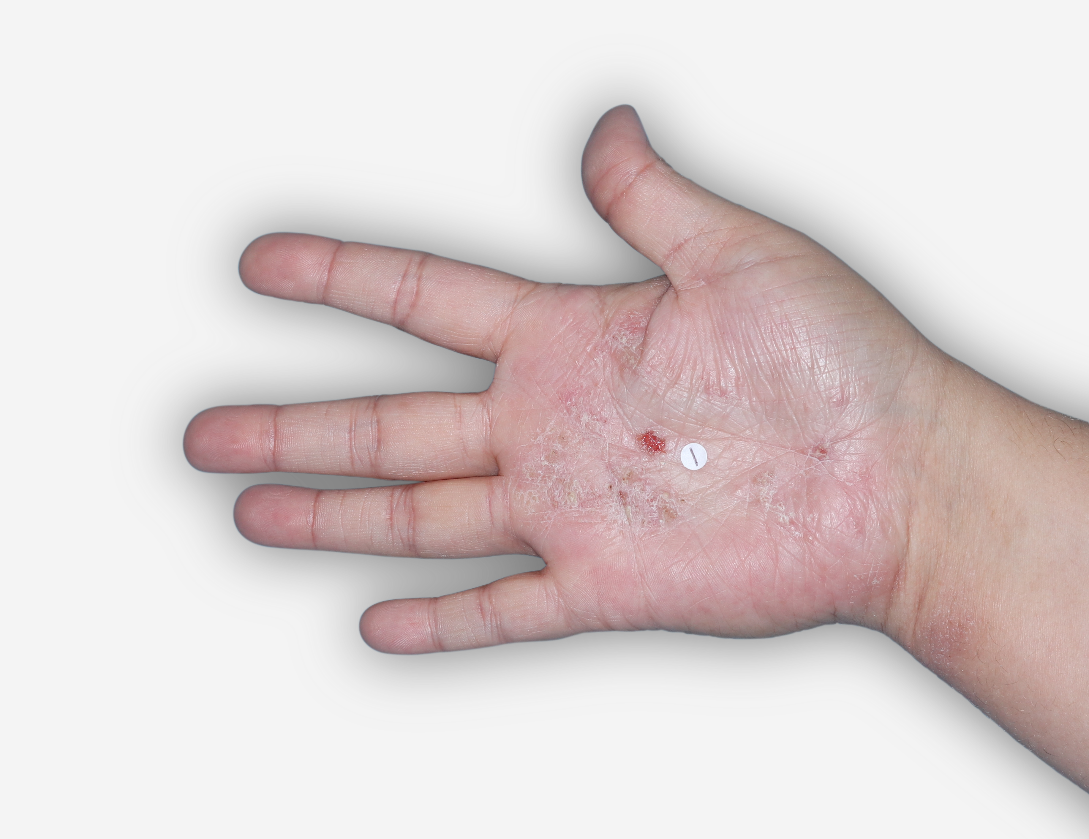 Before Treatment - A patient image of the palm with atopic dermatitis.