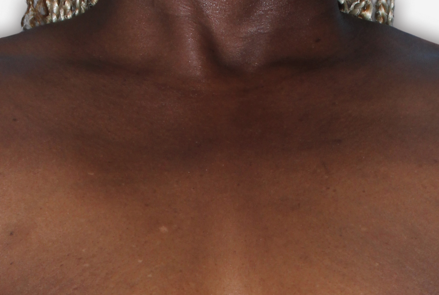 After Treatment - A patient with almost clear skin, chest shown.