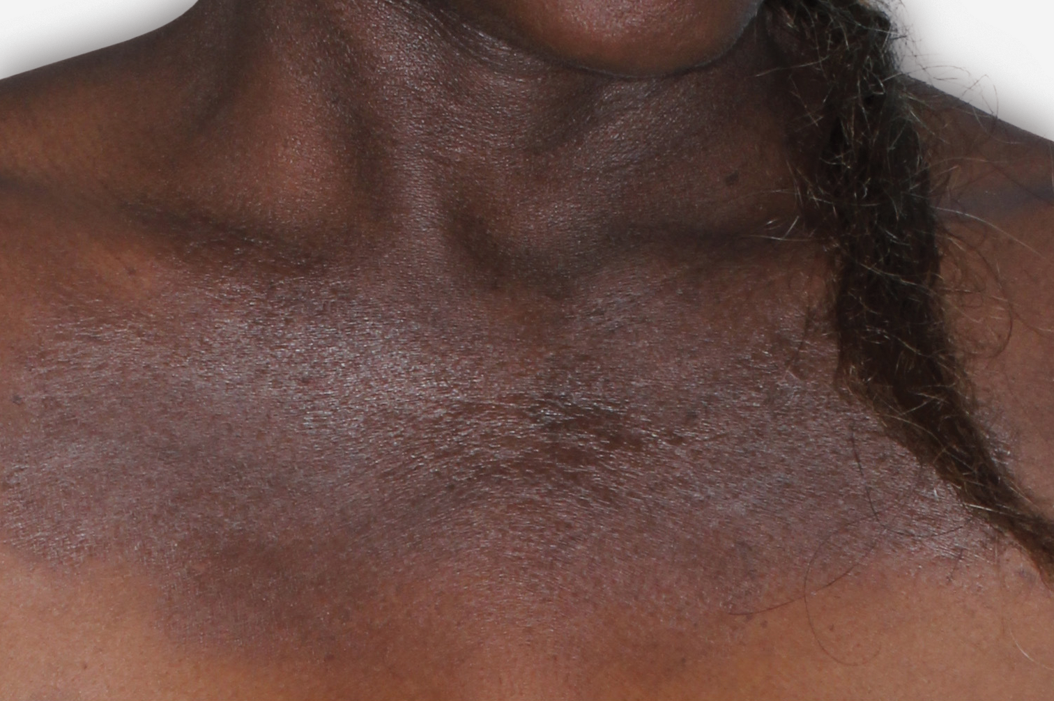 Before Treatment - A patient image of the chest with atopic dermatitis.