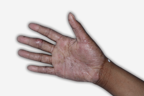 Before Treatment - A patient image of the palm with atopic dermatitis.