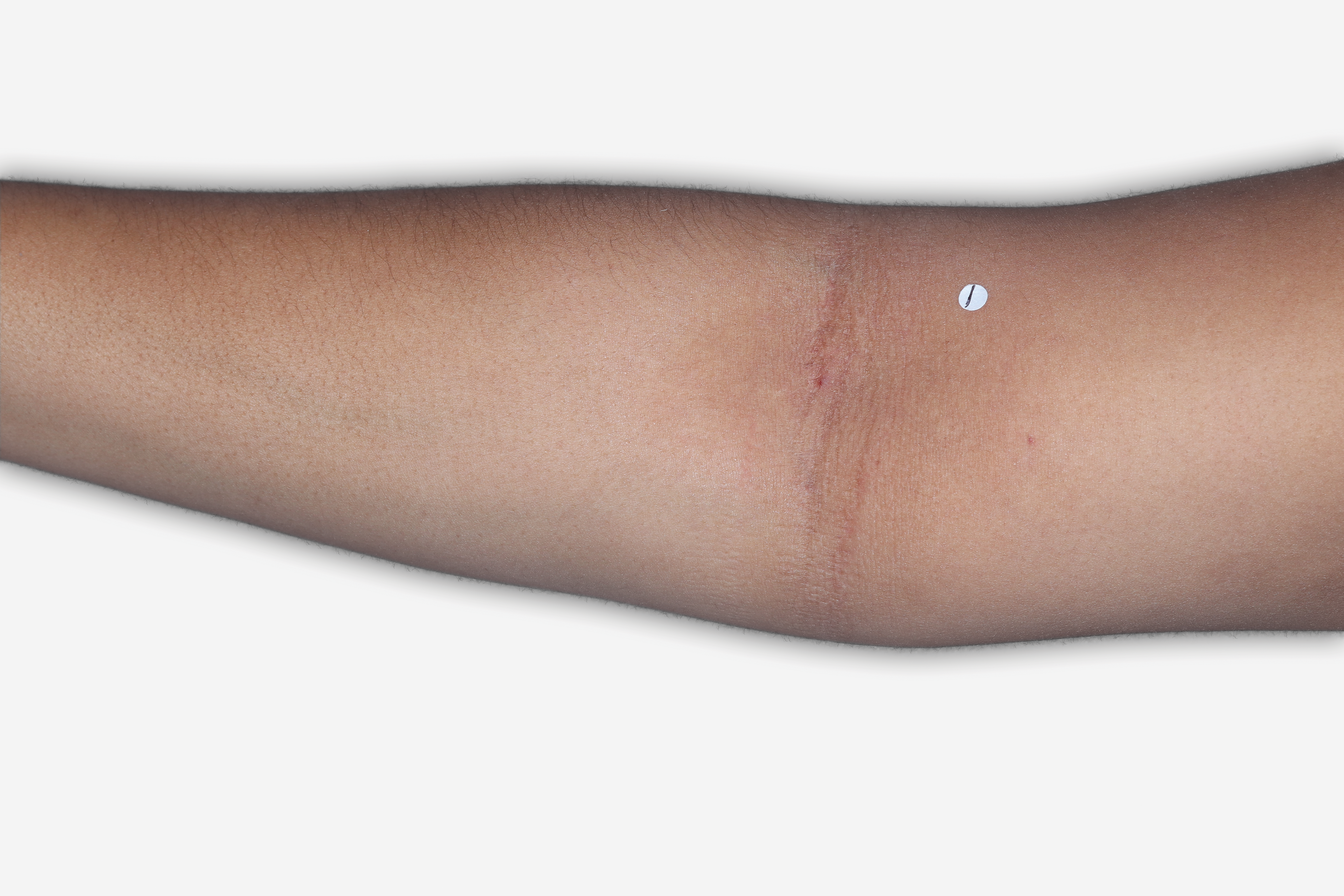 After Treatment - A patient with clear skin, inside of elbow shown.