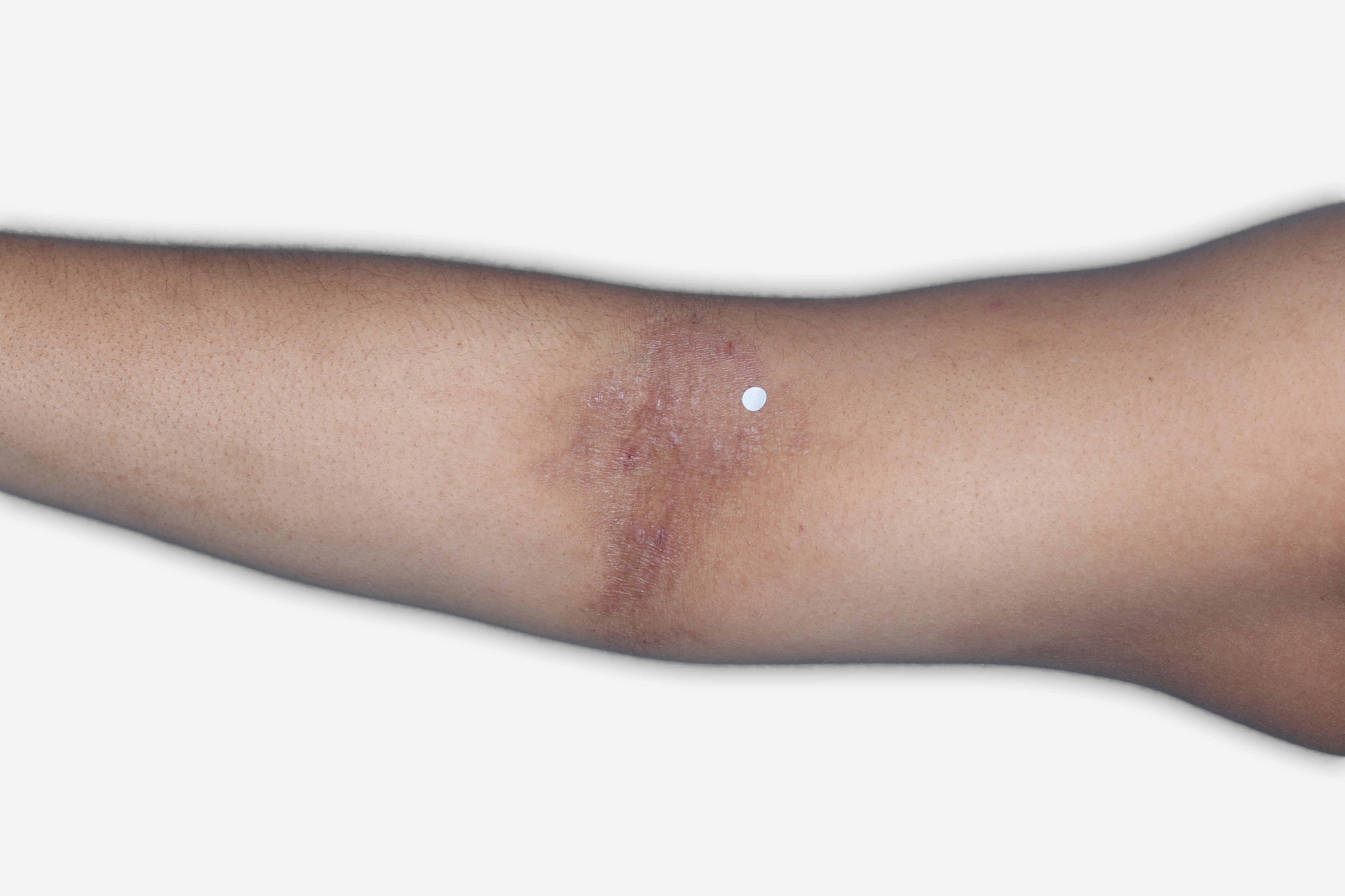 Before Treatment - A patient image of the inside elbow with atopic dermatitis.